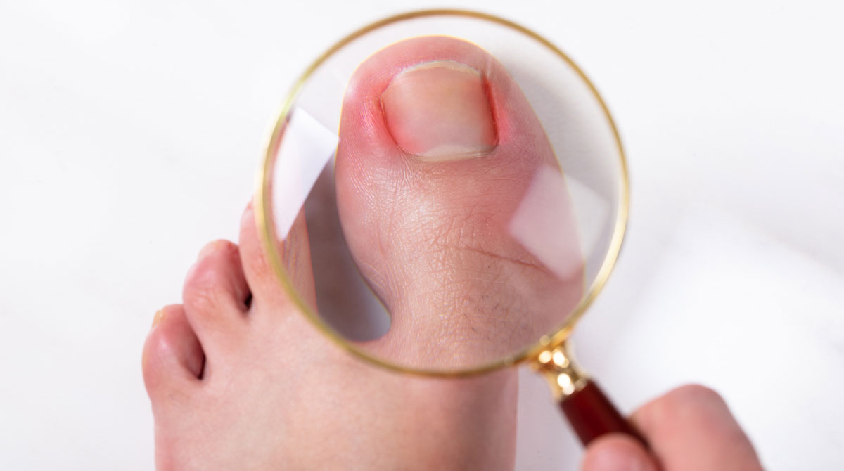 Magnifying glass showing a toenail that’s red and inflamed at the sides from an ingrowing toenail