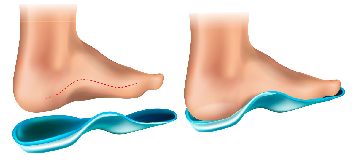 illustration depicting an orthotic that provides arch support