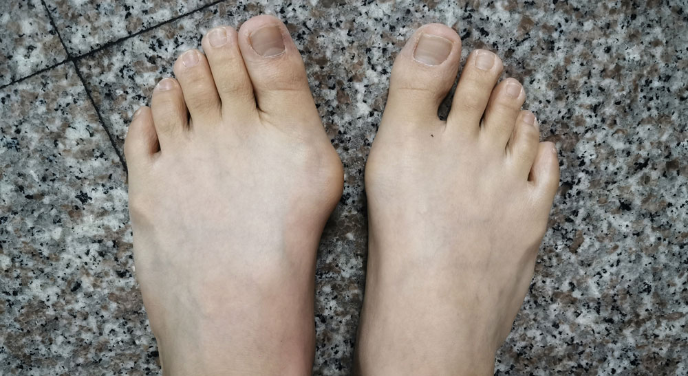 bare feet that have bunions