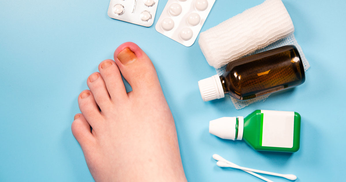 A foot with an inflamed ingrown toenail next to a range of pills and lotions
