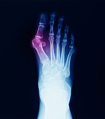 an x ray of a foot which has a bunion with colouring at the big toe joint suggesting bunion pain