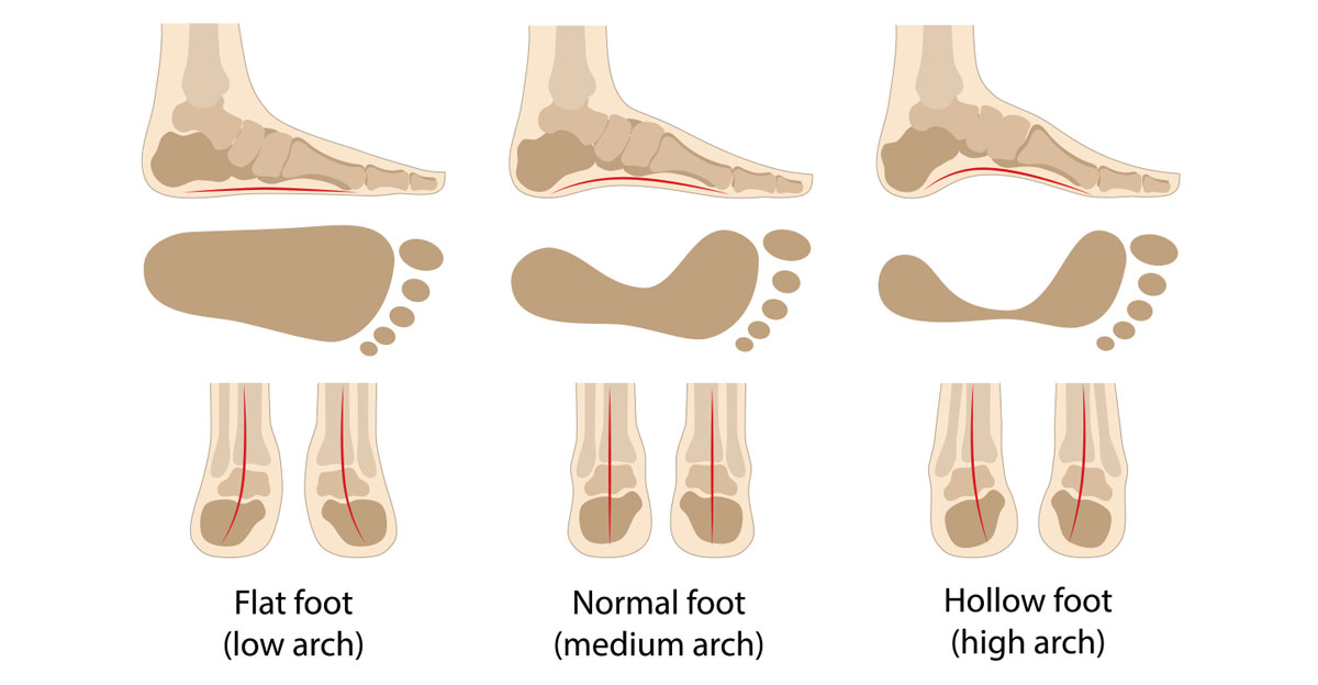 illustration comparing how arch heights affect footprint shape and tendency to pronation and supination