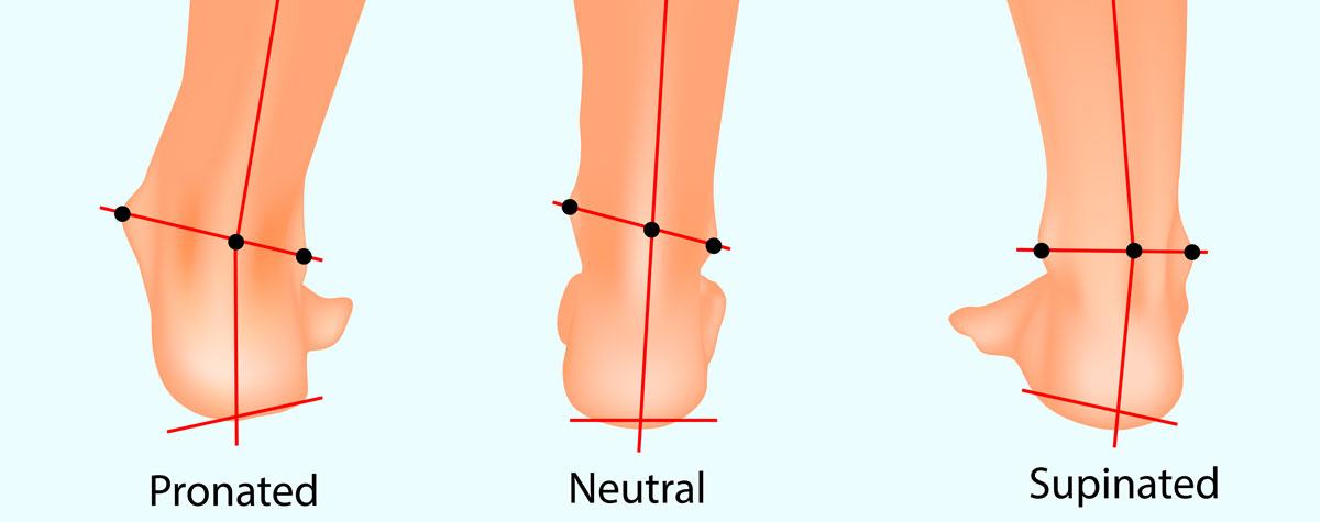 illustration of neutral pronated and supinated feet